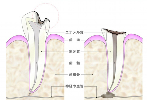 歯の構成と虫歯