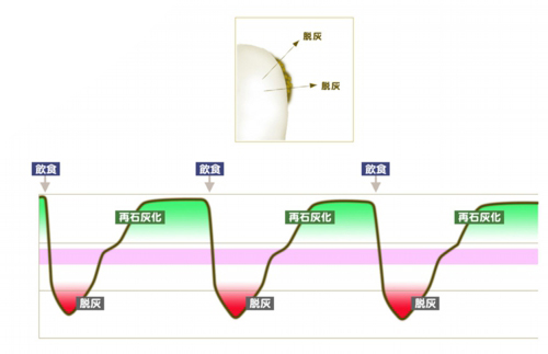 虫歯の原因となる脱灰と再石灰化歯について